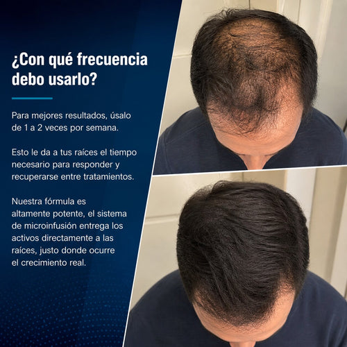 Alfavita™ Sistema Regeneración Capilar