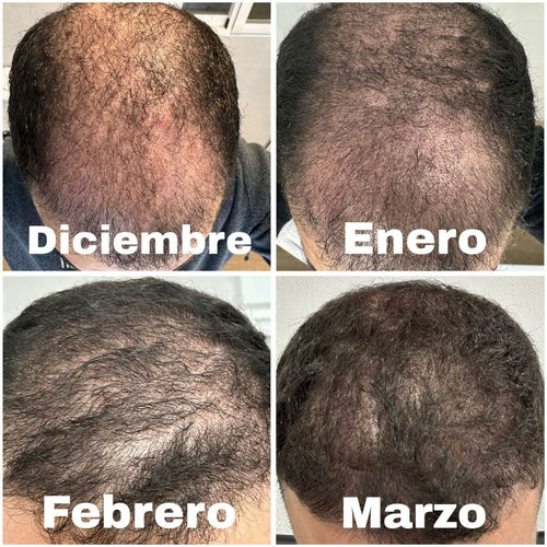 Kit Definitivo Para Crecimiento Capilar